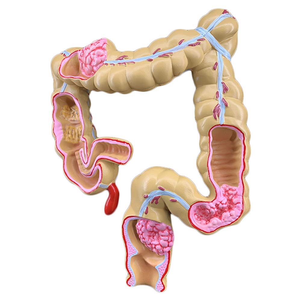 sjdoPulse Human Colorectal Lesion Model - Human Organ Anatomy Model Pathological Anatomical Model of Colorectal Disease - Pvc Material Pathological Anatomy Colon Diseases Intestine Model (A)