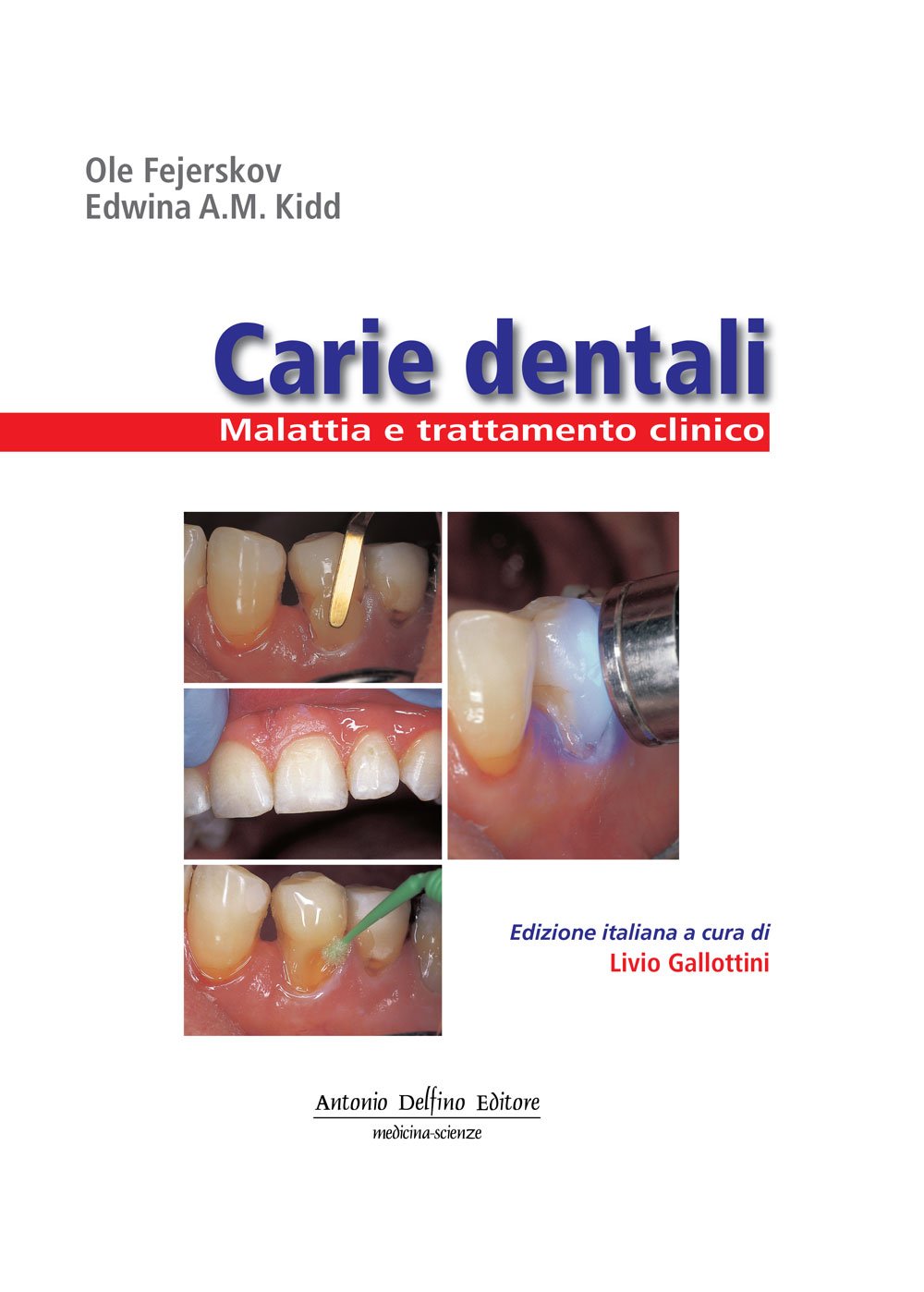 Carie dentali. Malattia e trattamento clinico. Ediz. illustrata