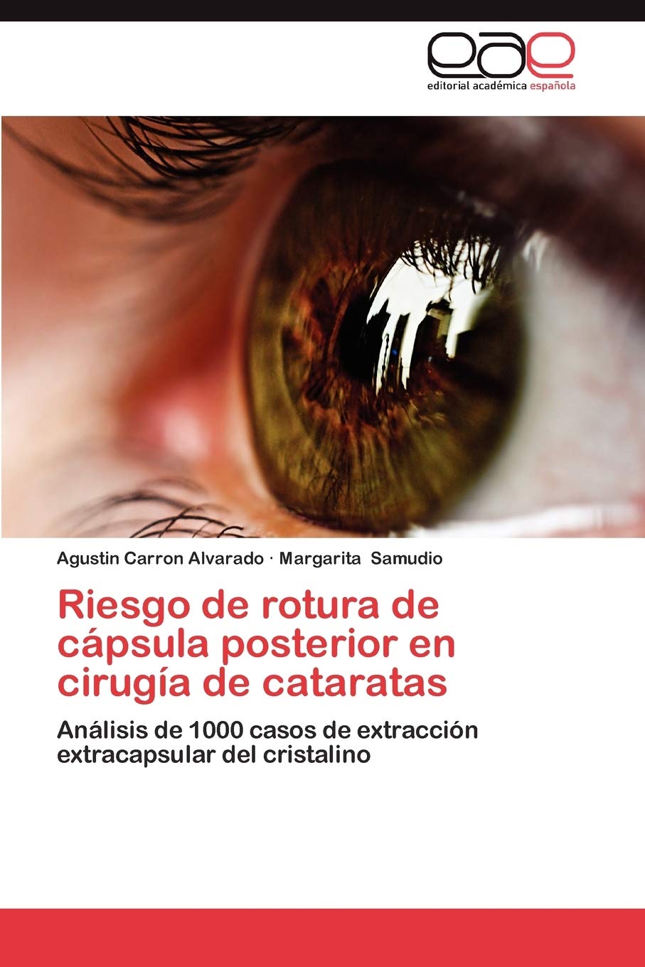 Riesgo de Rotura de Capsula Posterior En Cirugia de Cataratas