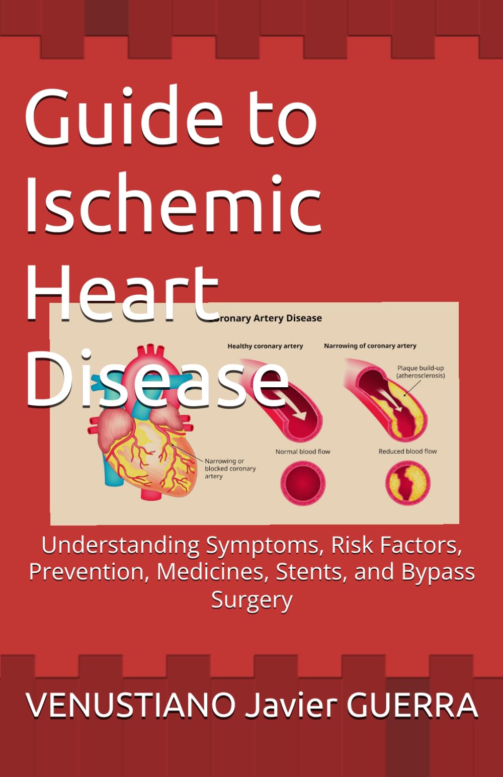 A Simple Guide to Ischemic Heart Disease: Understanding Symptoms, Risk Factors, Prevention, Medicines, Stents, and Bypass Surgery (Medical Publications for lay people)