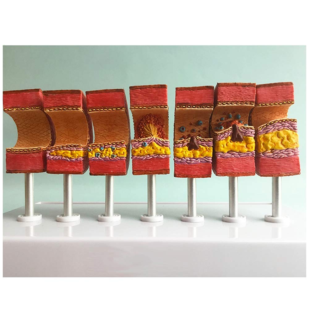 Anatomisches Modell der Arterie - Anatomisches Gefäß-Atherosklerose-Thrombus-Gefäß-Modell Modell der menschlichen Arterie - für das Studien-Display Lehre Medizinisches Modell
