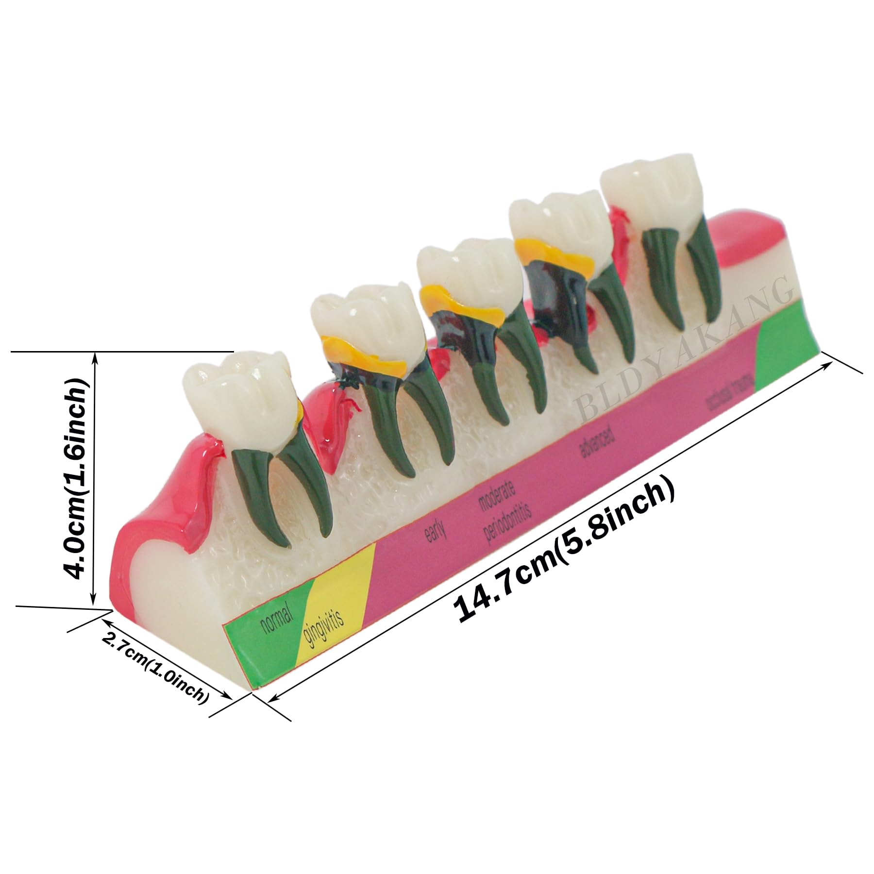 Dental Periodontal Disease Teeth Model Doctor-Patient and Oral Care Education Model Showing Gingivitis ~ Advanced Periodontitis 5 Stages