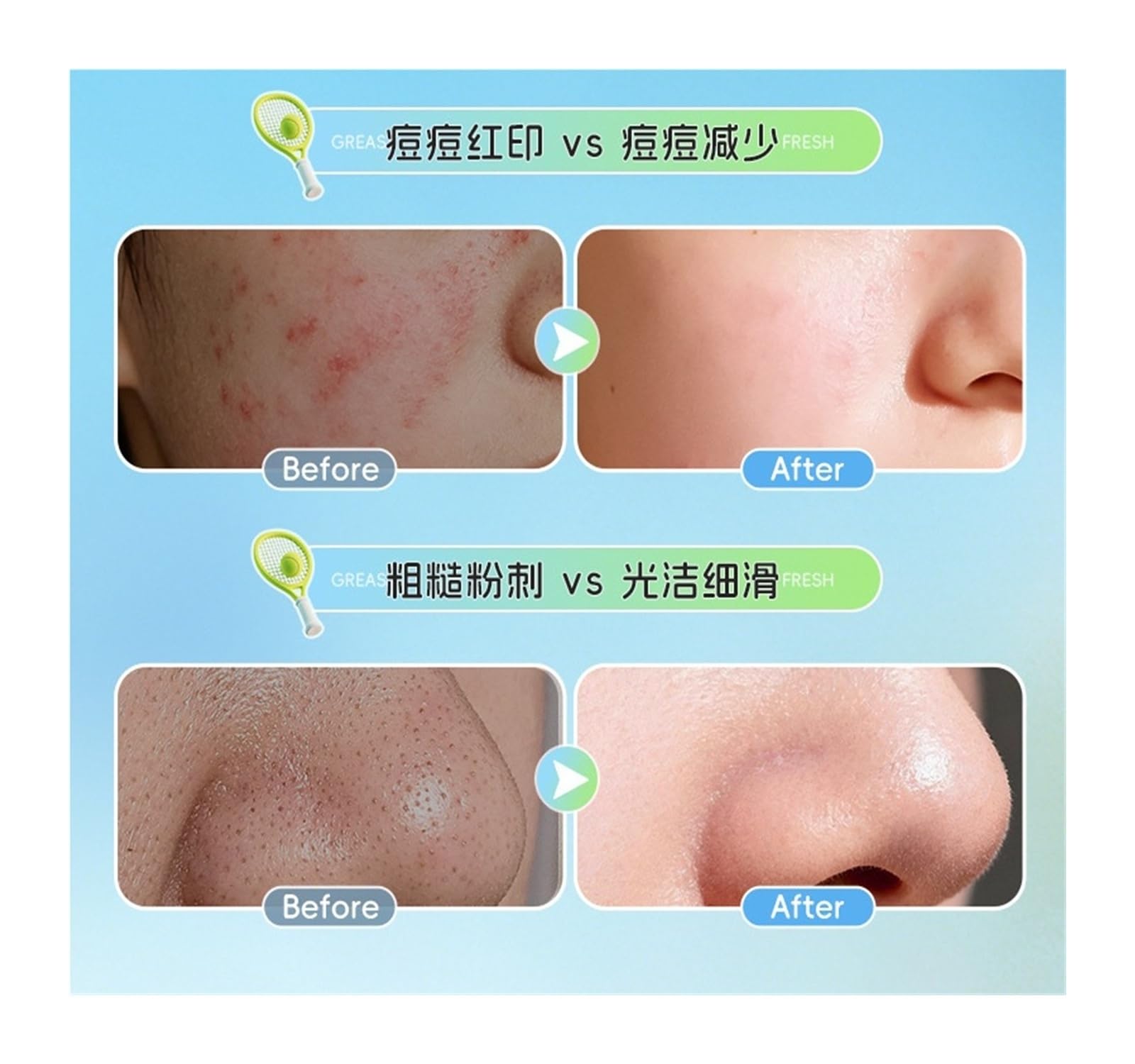 Limpiador facial antiacné, 300 ml | Controla la grasa, atenúa las cicatrices del acné e ilumina el tono de la piel.(2pcs)