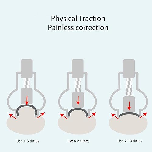 Miniatura 2 de Herramienta de cuidado de pies encarnados para el cuidado de los pies, abrazadera de uñas de acero inoxidable, herramientas de acero inoxidable
