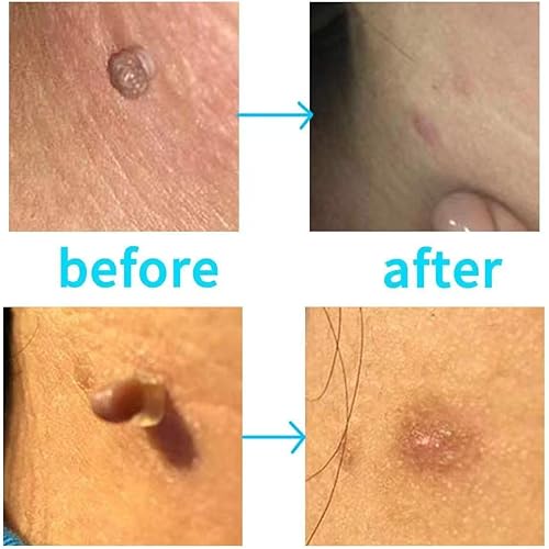 Miniatura 4 de Piegricdiat Removedor de verrugas, kit de eliminación de marcas en la piel