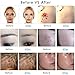 PicoSecond Nd: YAG Laser System – Portable Tattoo Removal Laser Pen with 9 Levels, Compact Beauty Tool for Home & Travel-QA02