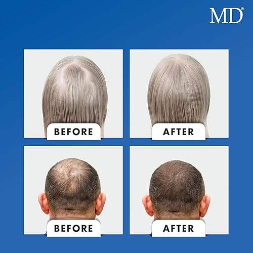 Miniatura 6 de MD Nutri Suplemento de apoyo para el crecimiento del cabello con biotina  30 cápsulas nutren desde dentro para un cabello de aspecto más saludable