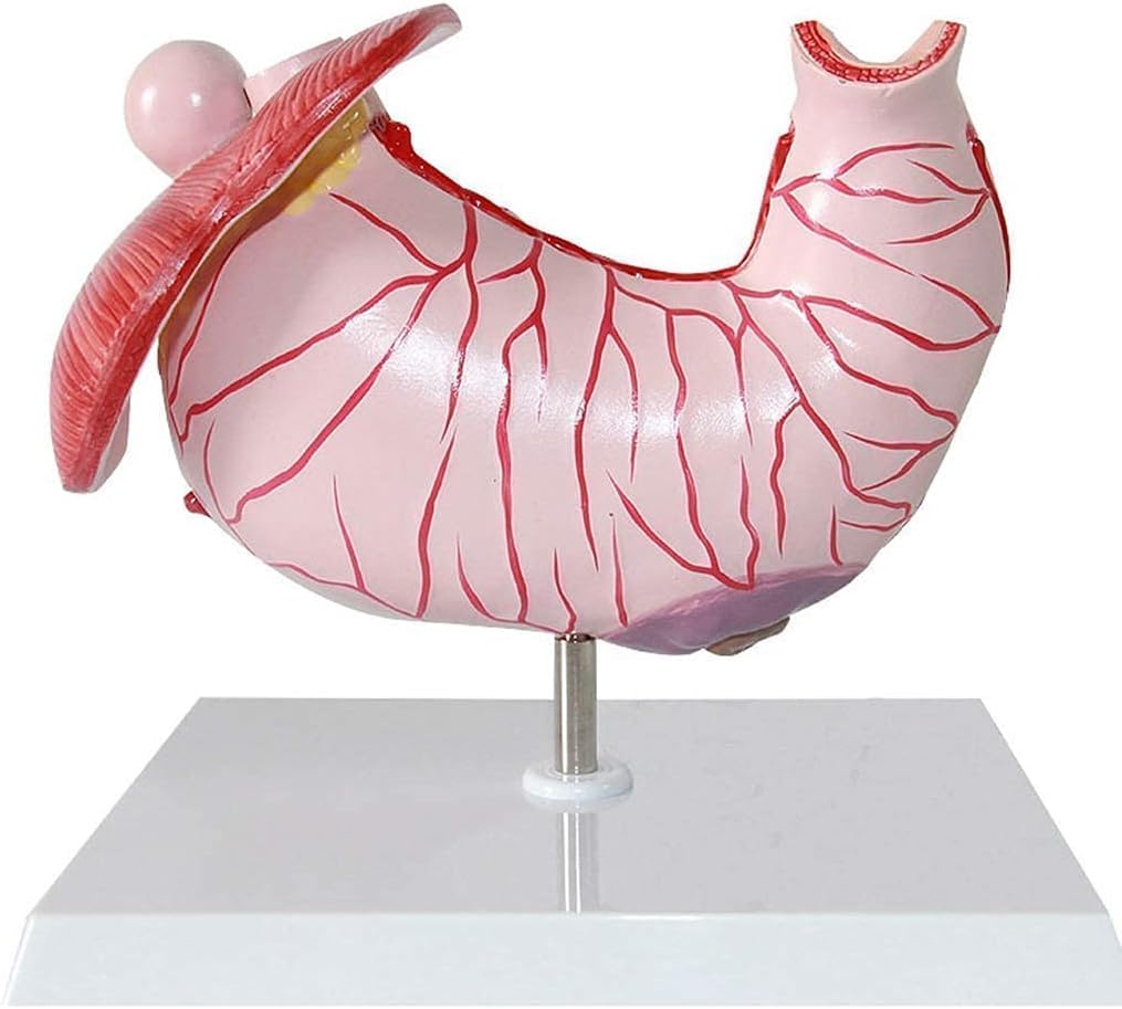Modèle d'anatomie gastrique et de gastrite pour les écoles médicales