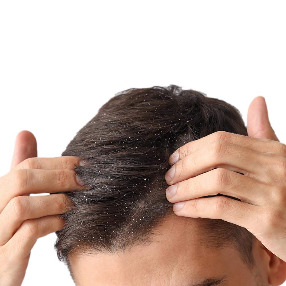 Dandruff Treatment & Symptoms | Request prescription for anti-dandruff shampoo, dry scalp medication like ketoconazole, ciclopirox (Loprox), steroid ointment from an online doctor, NP, or PA