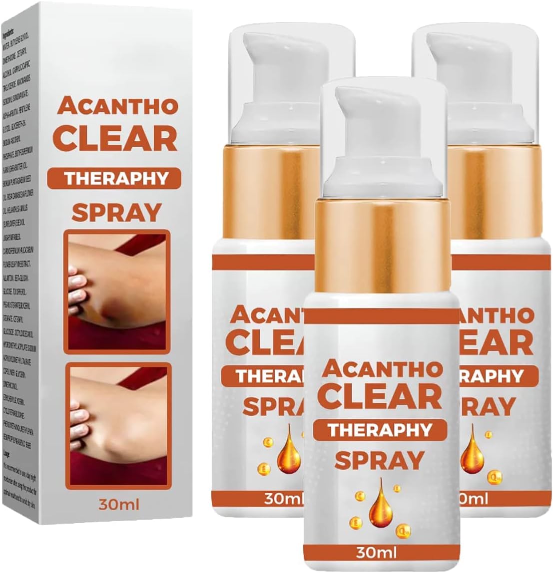 Acanthoclear Therapy Spray, Acanthosis Nigricans Therapy Oil, Dark Spot Corrector Spray, Dark Spots Remover for Black Skin, Mild and Non-Stimulating (3 PCS)