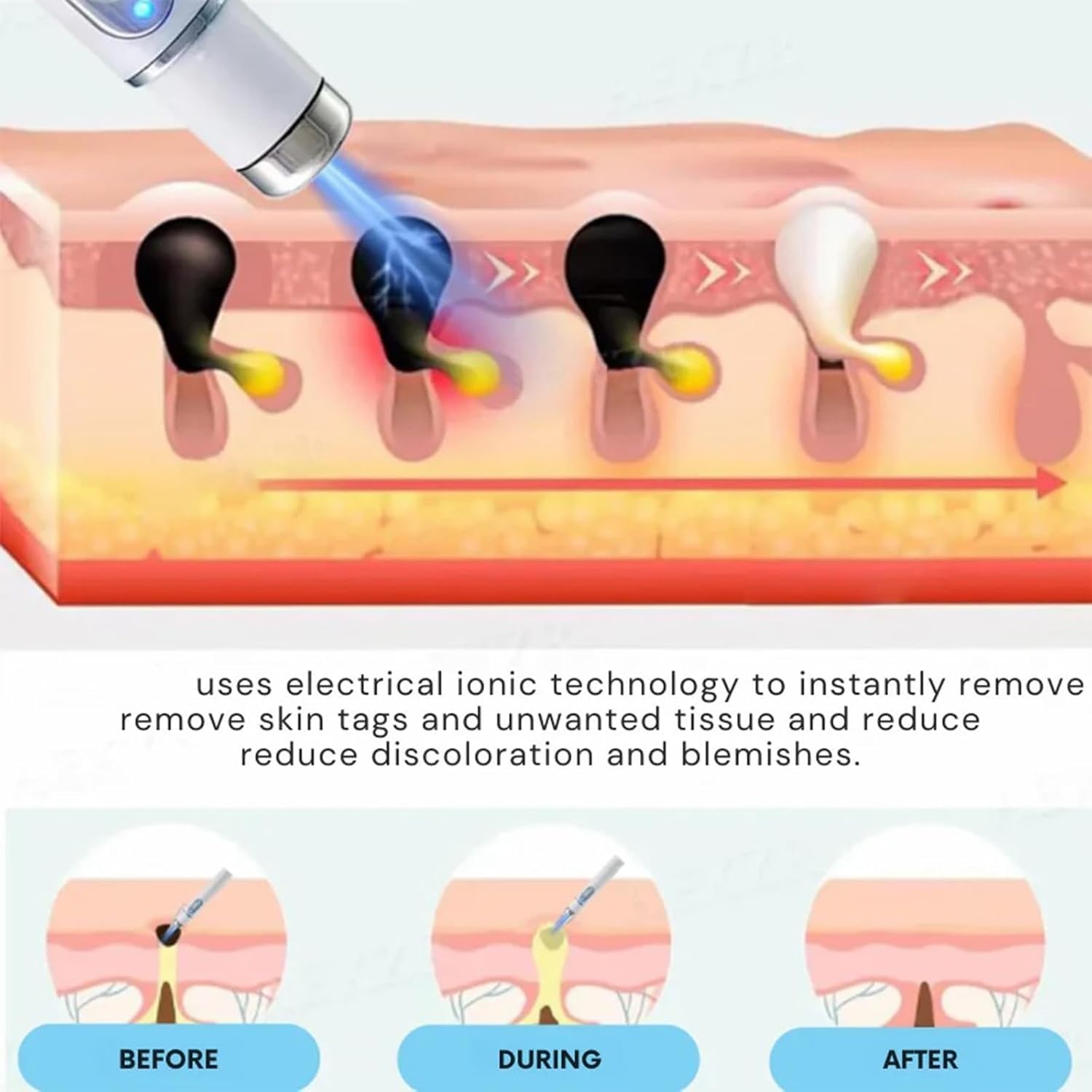 Penna laser non invasiva per la rimozione di lentiggini e verruche, penna laser per la crescita della pelle di viso e corpo, adatta per la rimozione di verruche, acne e nei