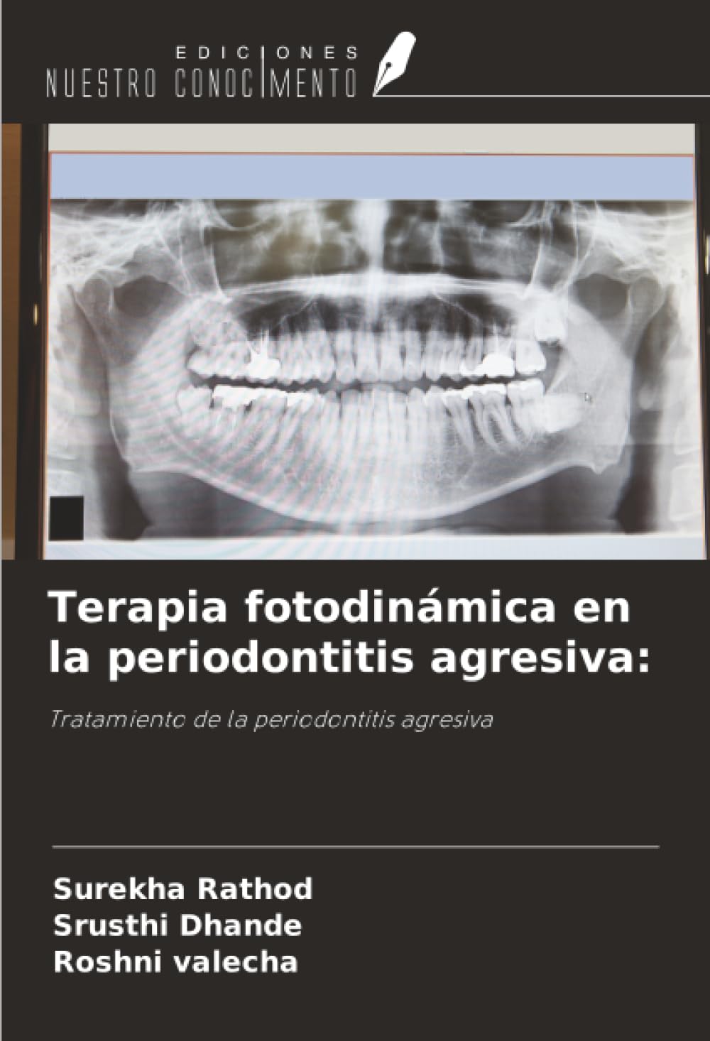 Terapia fotodinámica en la periodontitis agresiva:: Tratamiento de la periodontitis agresiva