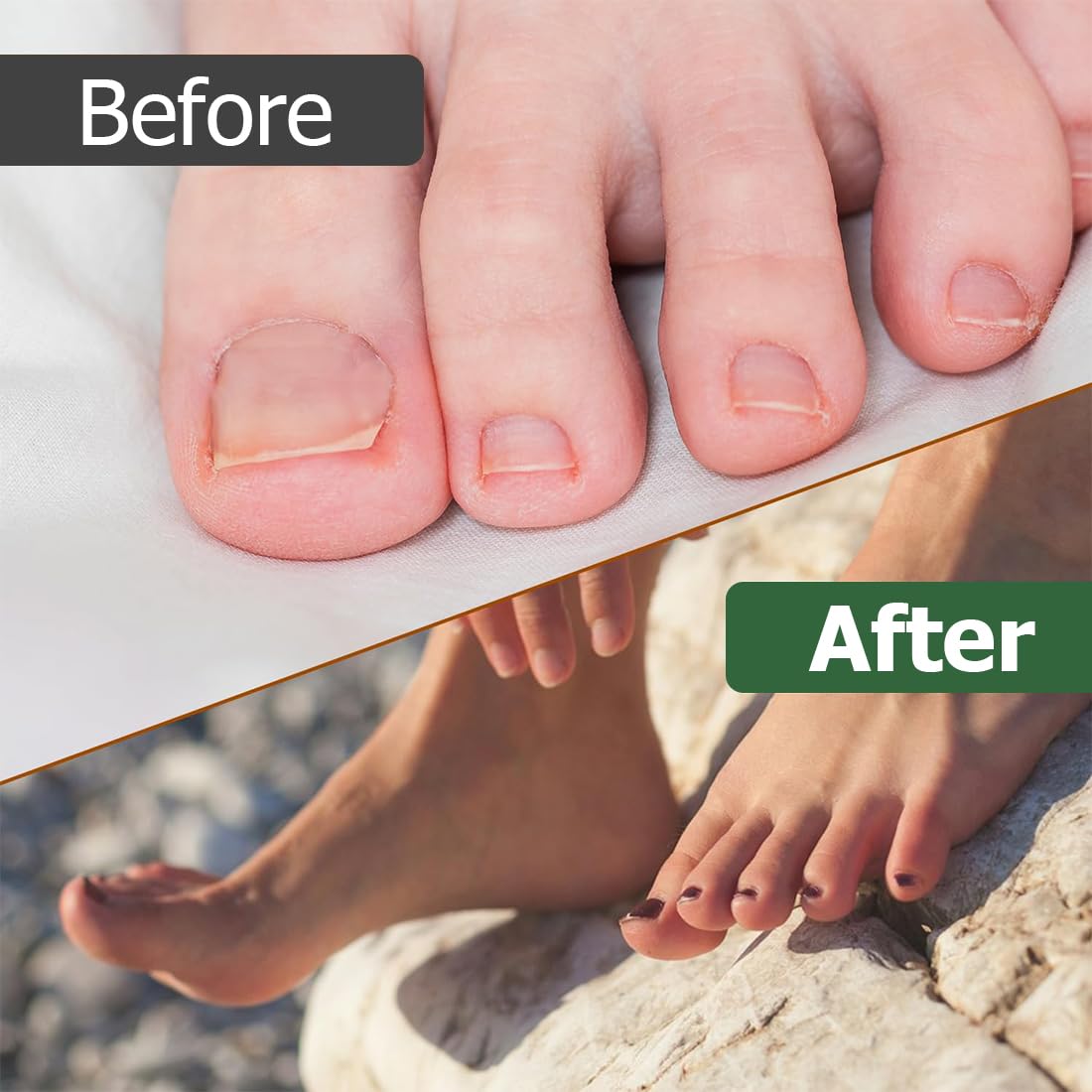 80 Piezas Korrección de Uñas Encarnadas, Parche Corrector de Uñas de los Pies,Parche de Corrección de Uña Encarnada Elástico, Pegatinas de Uñas Encarnadas, para Mujeres y Hombres