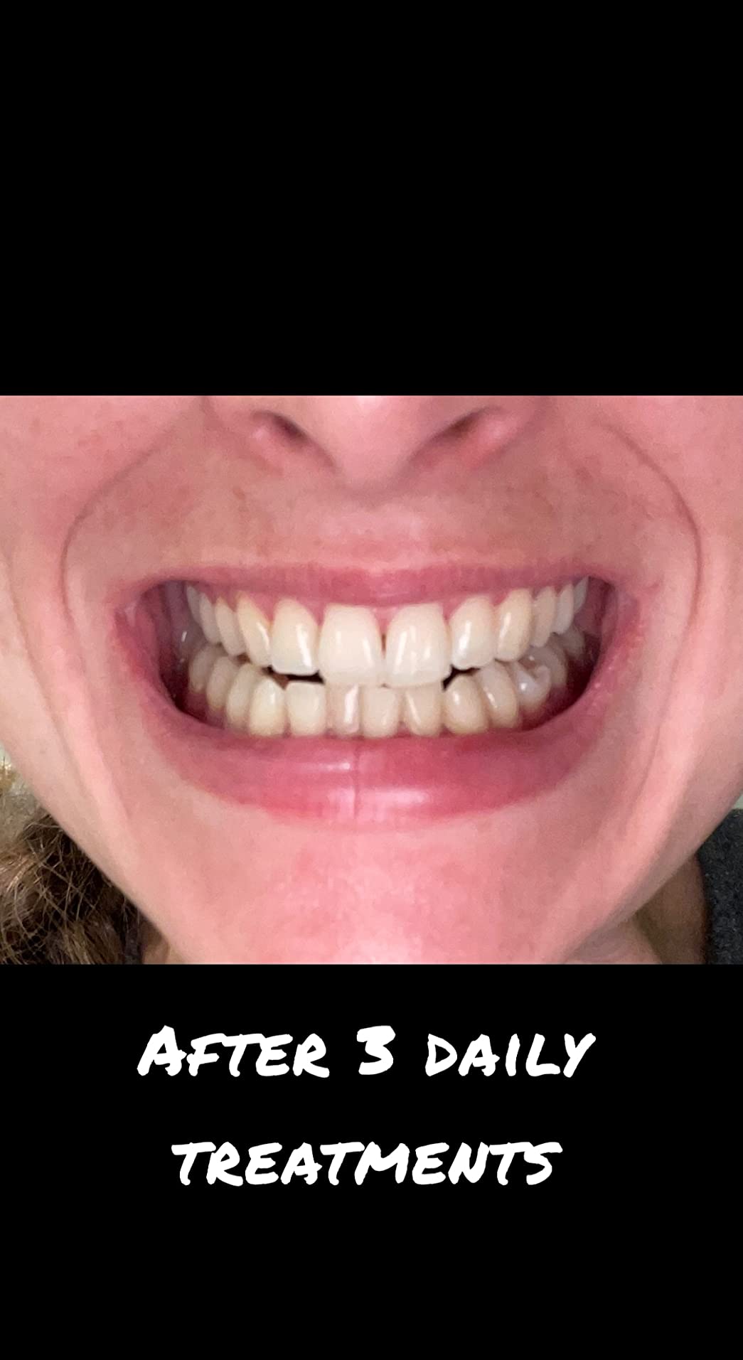 5/mo Finance VieBeauti Teeth Whitening Kit 5X LED Light Tooth