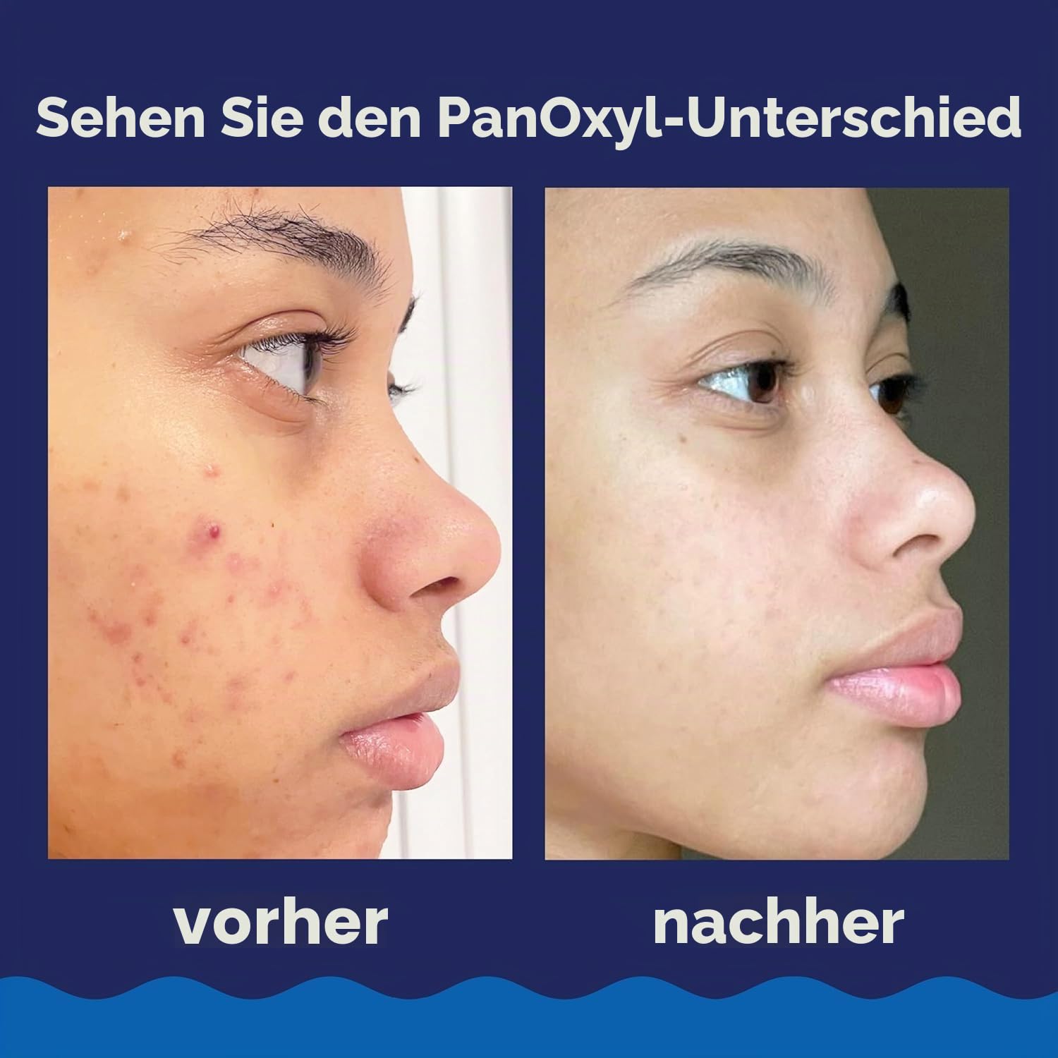 PanOxyl Foaming Wash Akne Reinigungsschaum für Gesicht und Körper 156 g - 3er Pack