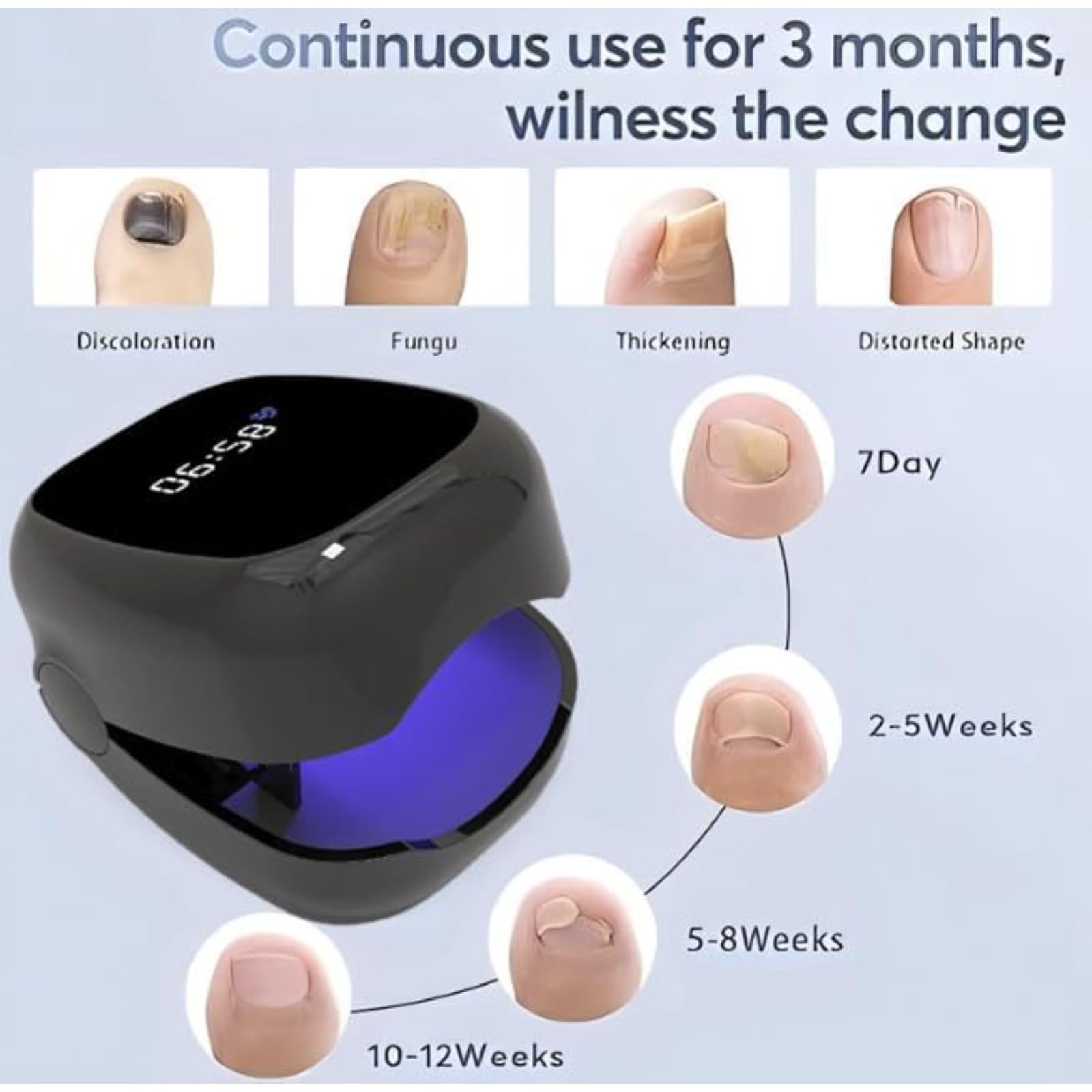 OrthoVital Appareil Anti Mycose - pour les Doigts et les Orteils Traitement Portable Dispositif Des Champignons Des Ongles, LaserEffective Appareil Mycose Ongle Pied (blanc)