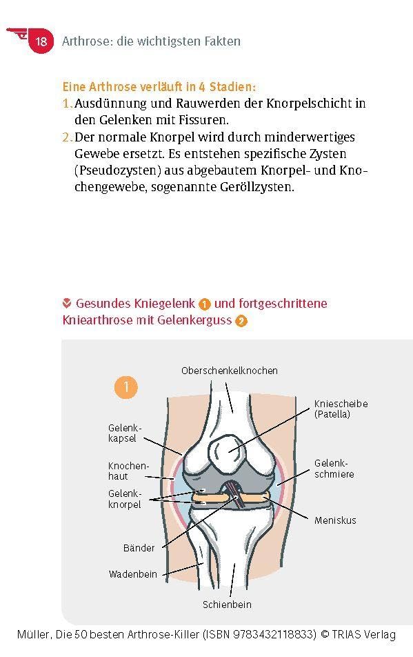 Die 50 besten Arthrose-Killer