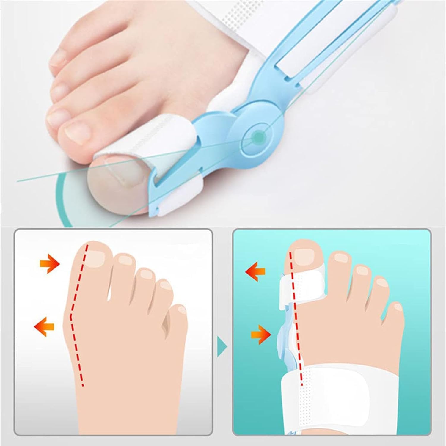 Toe Separators Bunion Night Splints,Bunion Corrector, Day & Night Bunion Pain Relief for Men & Women, Correctors ​for ​Big Toes Bent Toes(Yellow,L)