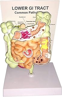 Study Model Human Digestive System Model - Gut Anatomy Intestinal Lesion Cecal Rectum Duodenal Ulcer Anatomical Model - PVC Human Large Intestine Pathology Model for Medical SaiFei