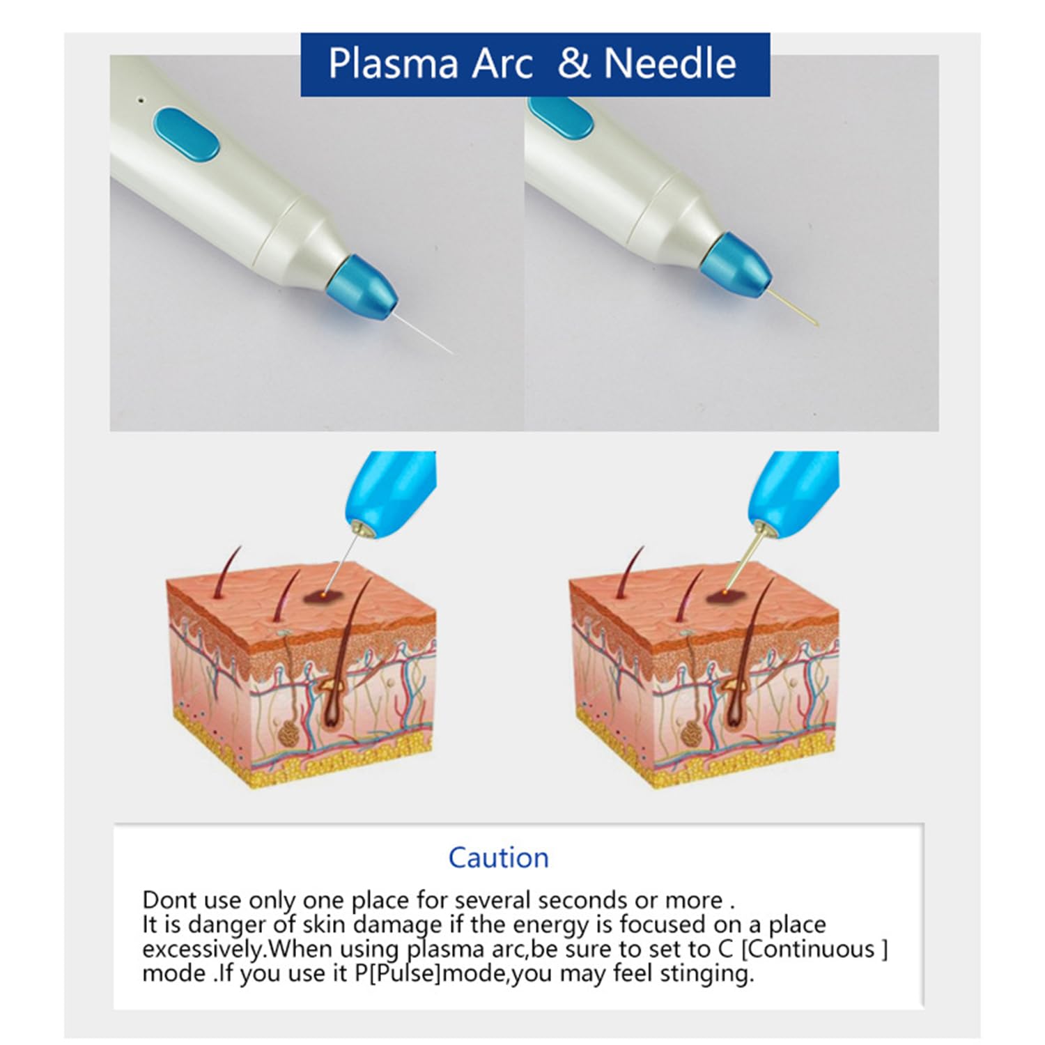 Maulwurfentferner Stift - Fibroblast Plasma Pen mit 5 Stärkestufen & 5 Ersatzköpfen, LED-Display für Augenlidliftung, Warze, Sommersprossen & Faltenentfernung