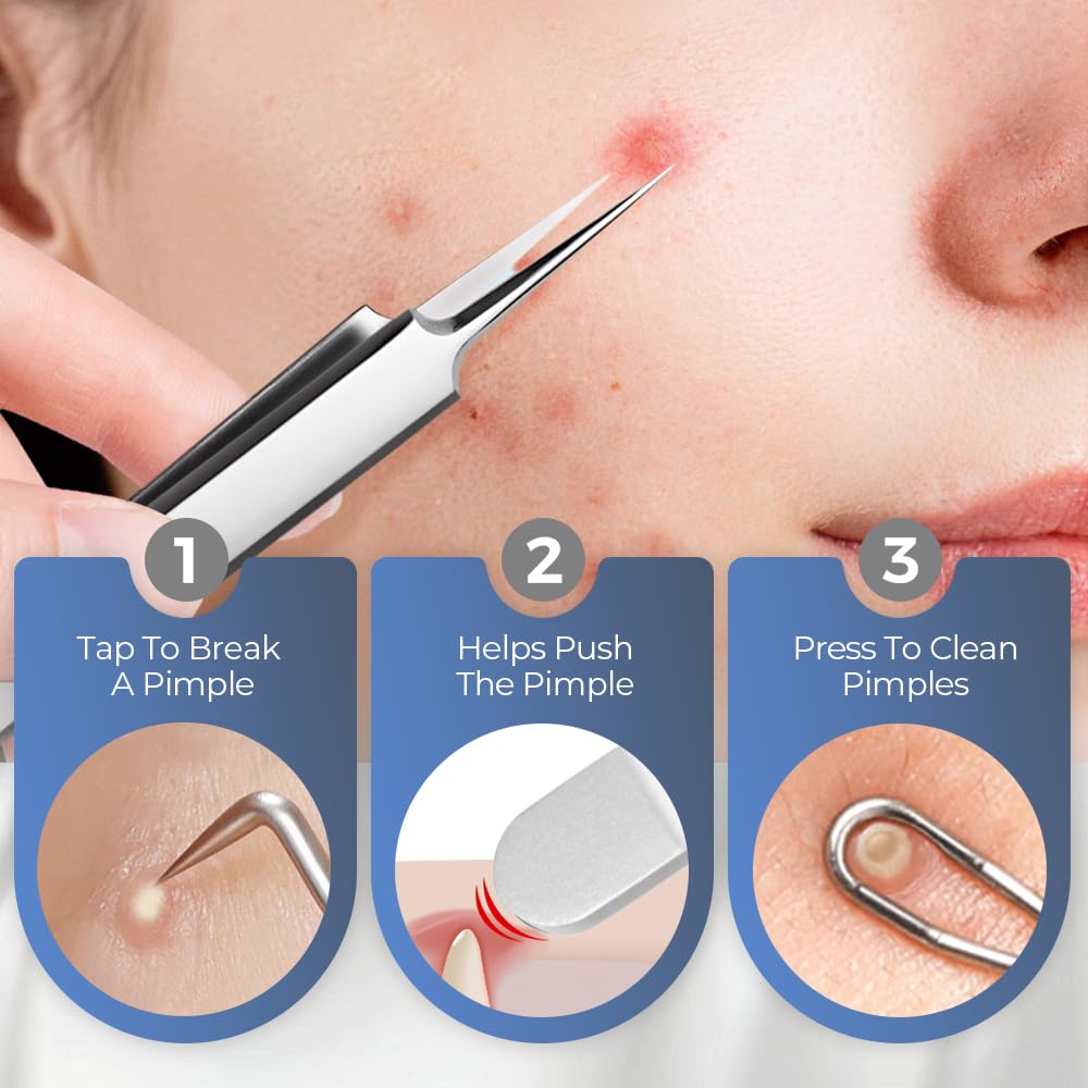 Kit di strumenti per l'estrazione di punti neri di grado medico, pinzette professionali in acciaio inox per rimuovere acne e punti neri, strumenti di estrazione per estetisti (9 pezzi (con lente
