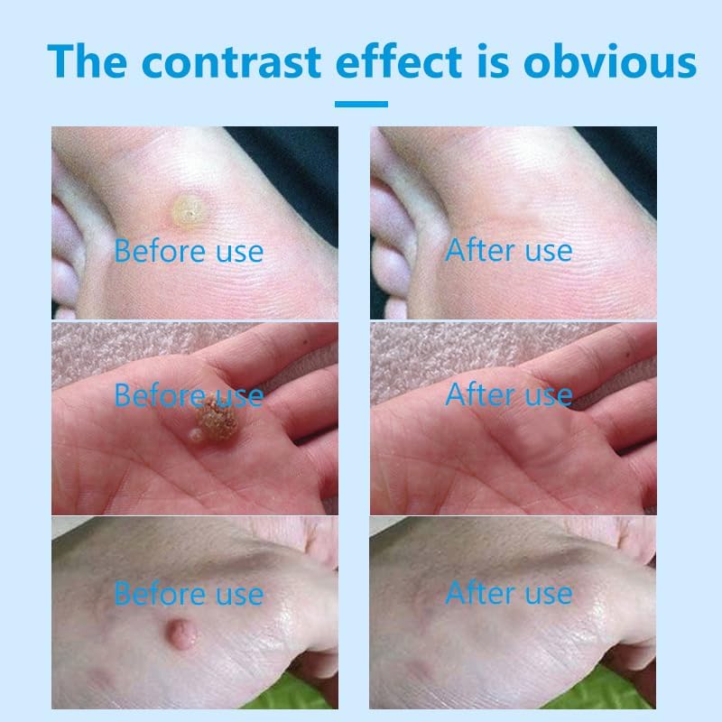 Miniatura 3 de DERMFREE BITANK LIGUID - Removedor de verrugas de acción rápida con ácido salicílico, verrugas plantares, verrugas comunes, 1 floz (1.0 fl oz)