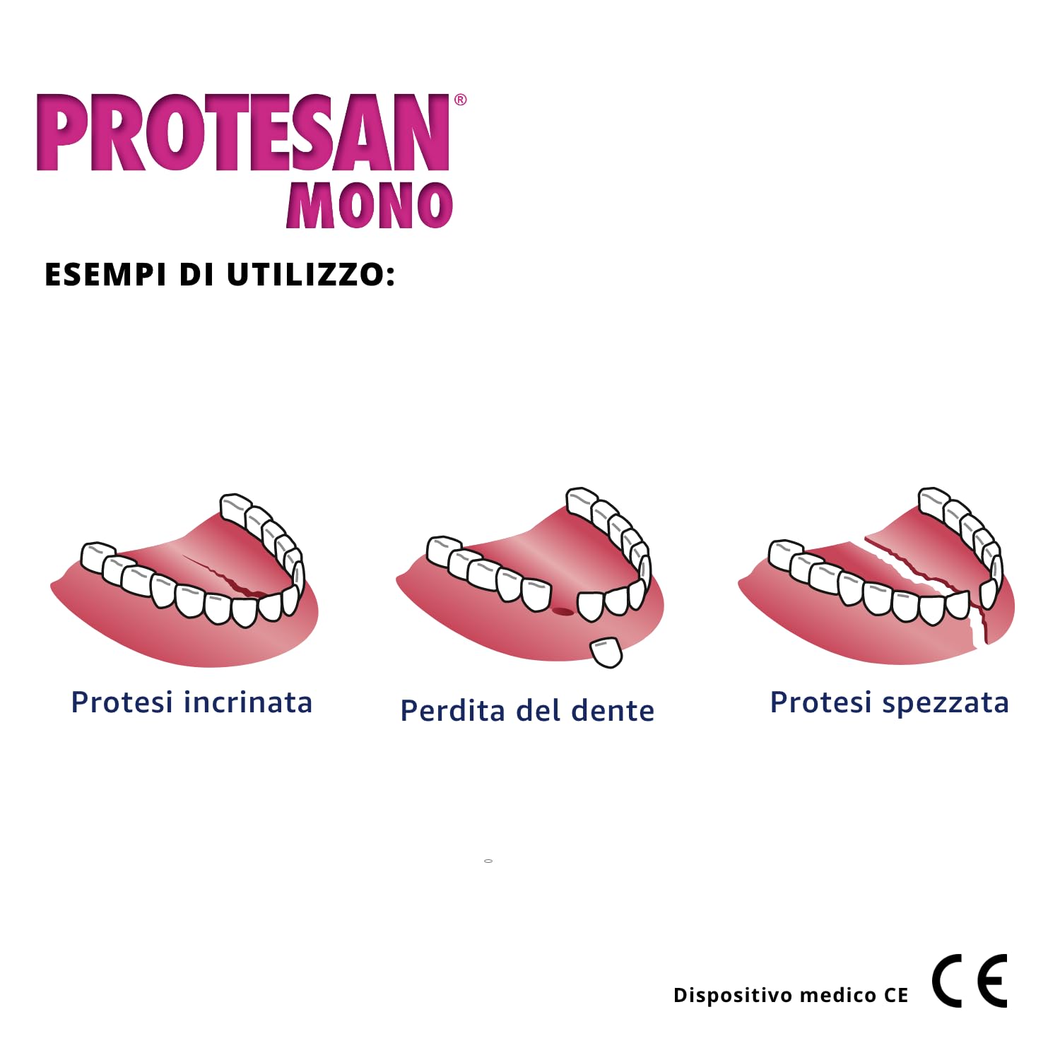 Protesan Mono - Riparatore per Dentiere Spezzate, Incrinate o Che Hanno Perso un Dente
