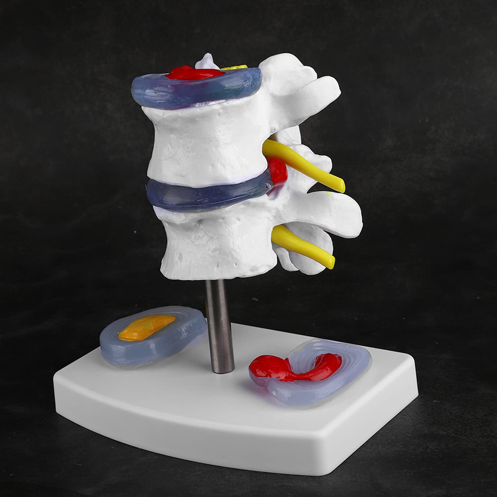MIIRR Lendenwirbelsäulen-Modell Mit Bandscheibenvorfall – Anatomisches PVC-Modell Für Medizinunterricht & Patientenaufklärung