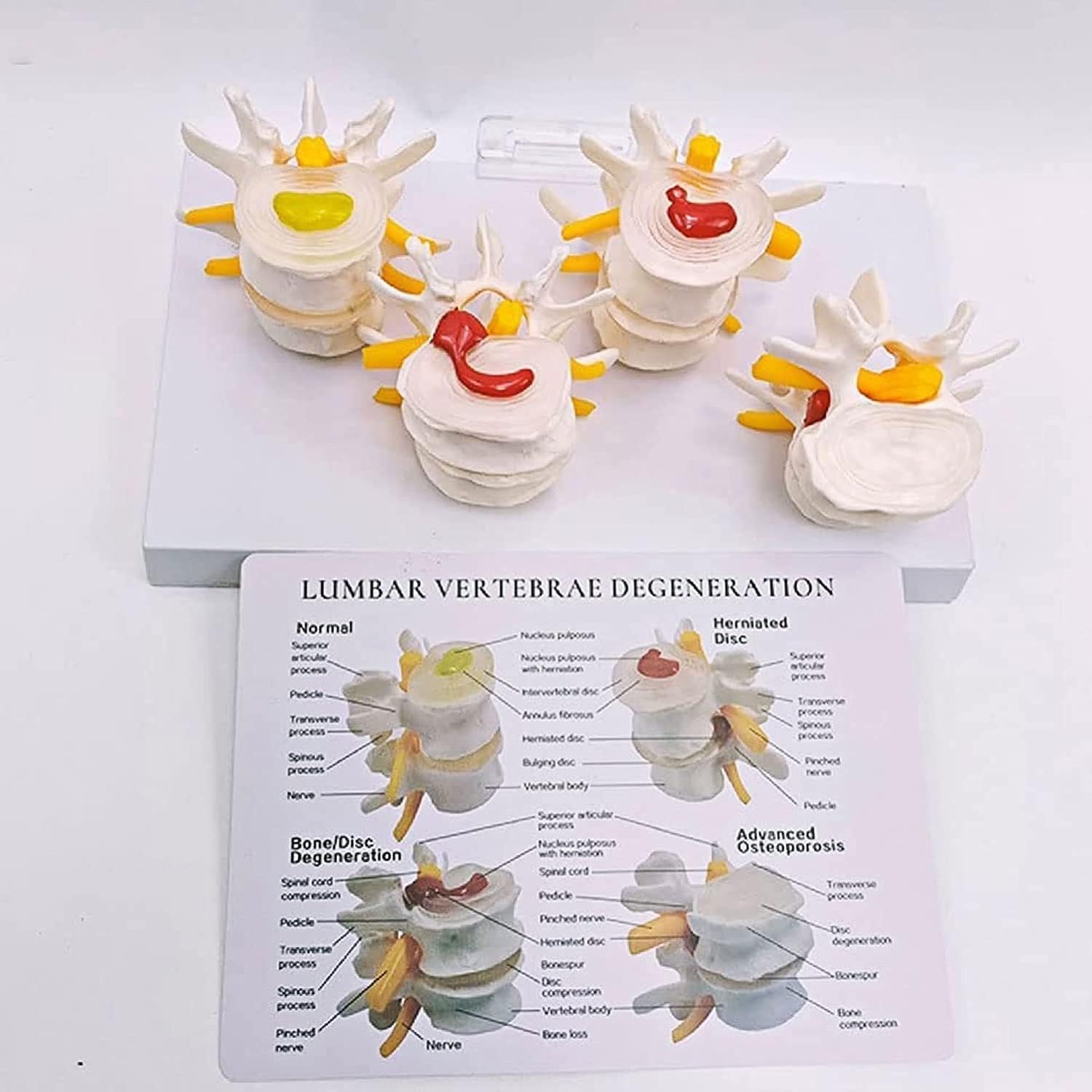 Modello di Vertebre a 4 Stadi, Modello di Ernia del Disco Intervertebrale di Scheletro Umano, Modello di Colonna Lombare Patologica, con Scheda Posteriore Inglese, per Studio Medico E Aule