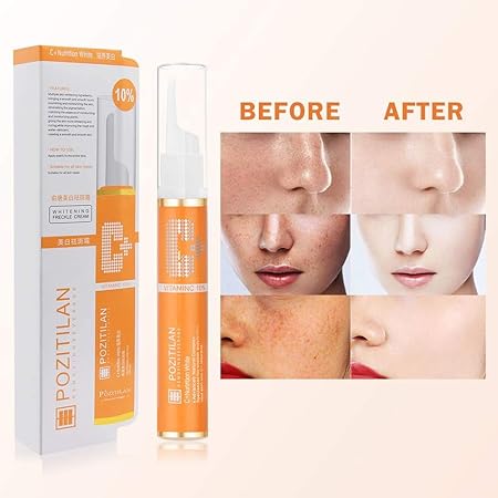 melasma removal cream