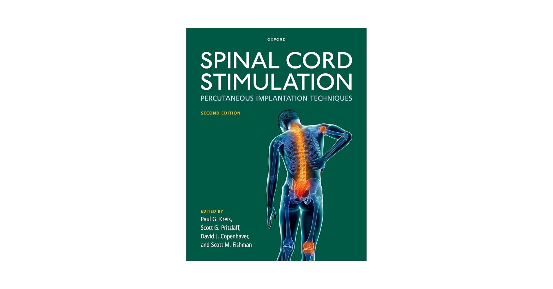 Spinal Cord Stimulation: Percutaneous Implantation