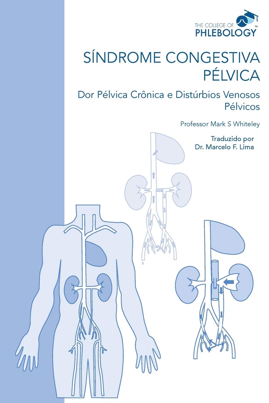 SINDROME CONGESTIVA PELVICA Dor Pelvica Cronica e Disturbios Venosos Pelvicos
