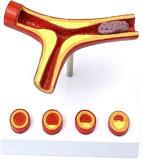 解剖モデル動脈硬化モデル動脈硬化モデル冠動脈疾患血栓モデル医学教育デモモデル