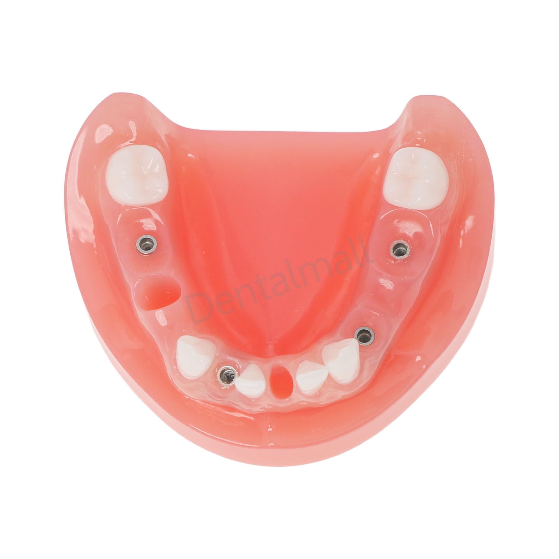 Dental Implant Typodont Restoration Teeth Model Lower Jaw M6019