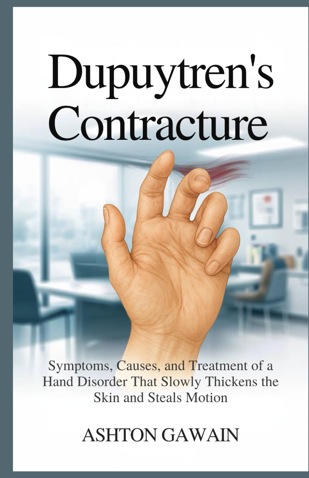 Dupuytren’s Contracture: Symptoms, Causes, and Treatment of a Hand Disorder That Slowly Thickens the Skin and Steals Motion