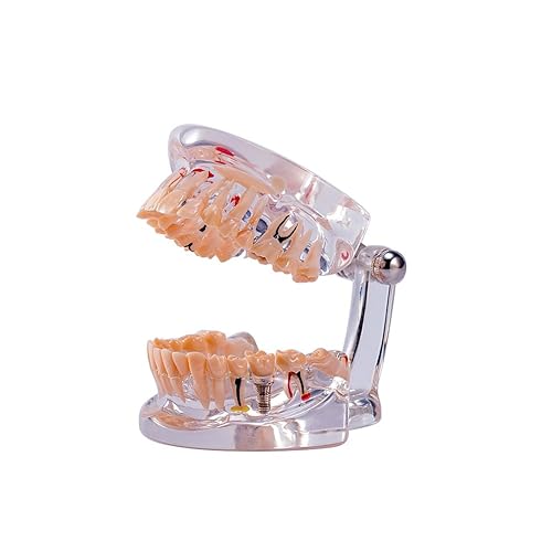 SNAWOP Modelo de patología dental con implante y dientes de enfermedad transparente estándar tipodont para dentista y educación del paciente