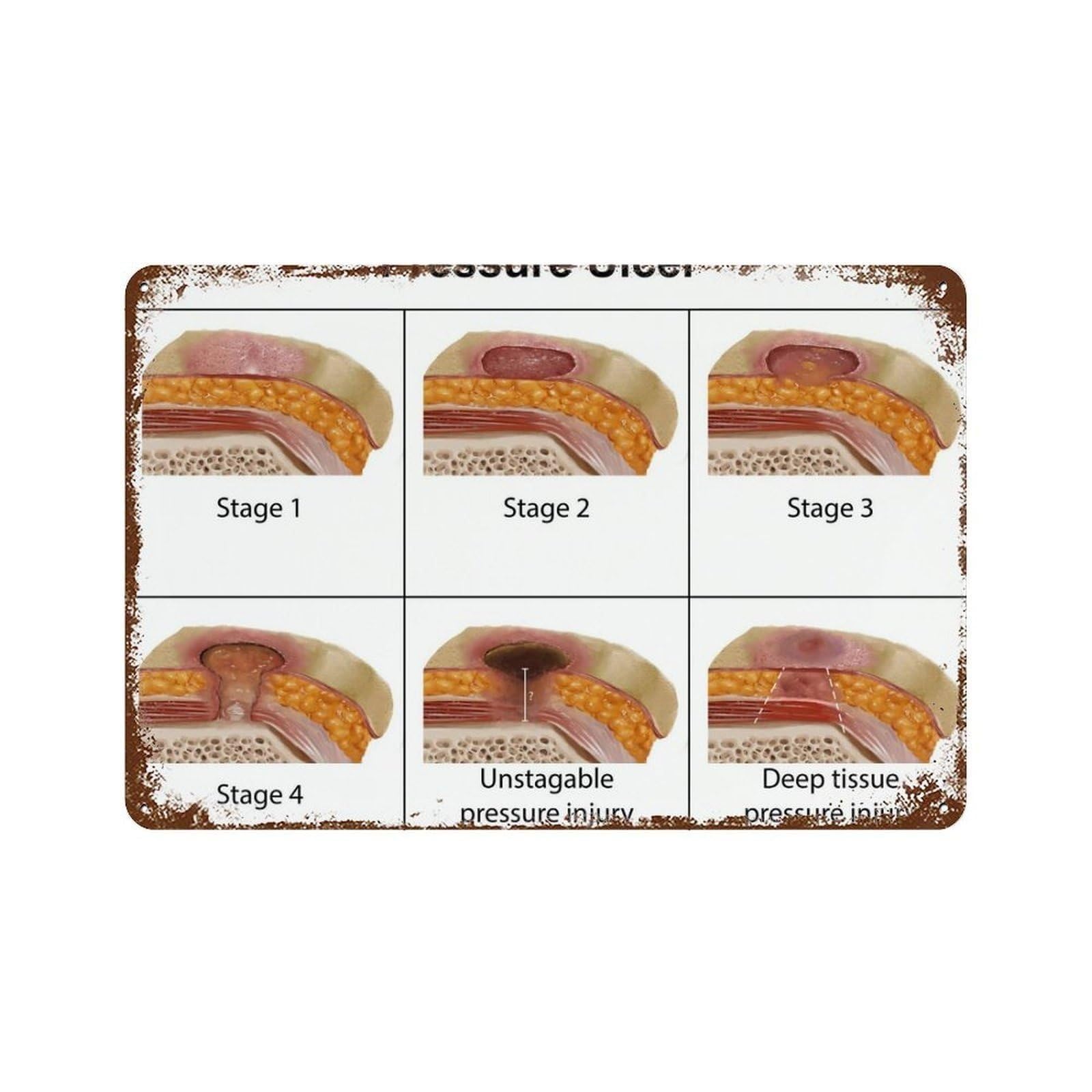 FNYUVNFAF Pressure Ulcer Stages Metal Tin Sign Anatomy Educational Chart Diagram Vintage Nursing School Wall Decor for Clinic Office 8 X 12 inch