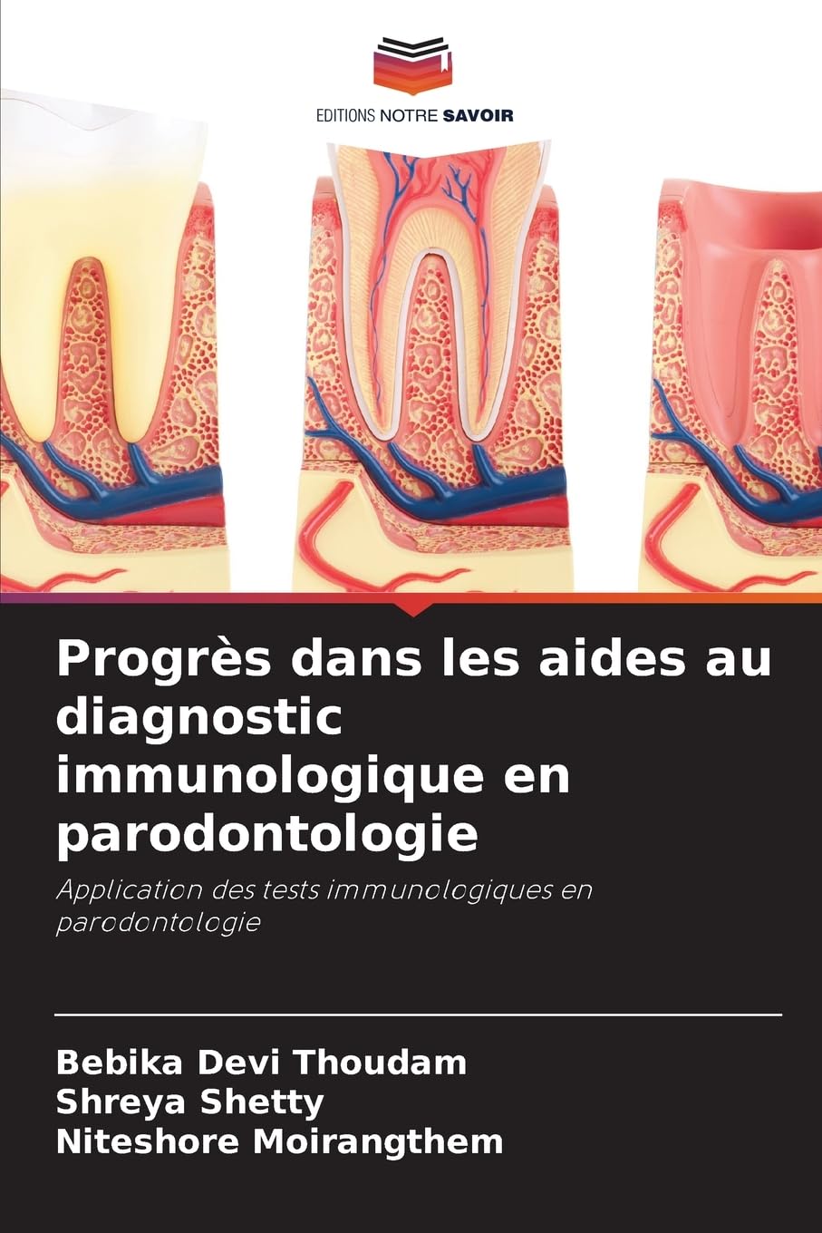 Progrès dans les aides au diagnostic immunologique en parodontologie: Application des tests immunologiques en parodontologie