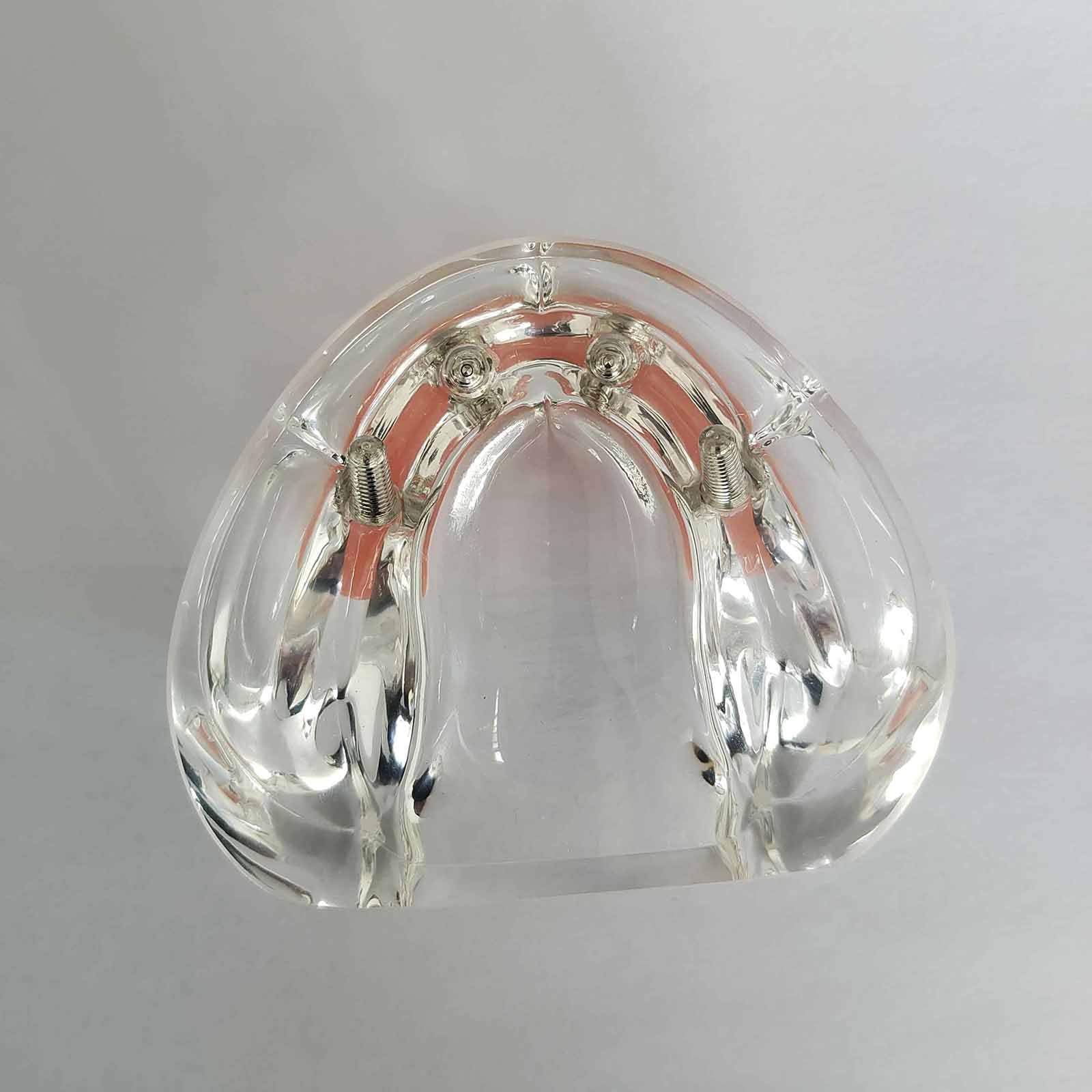 Modèle d'overdenture Modèle de typodont Dentaire Modèle d'implant pour la Recherche, l'enseignement et l'étude en médecine Dentaire