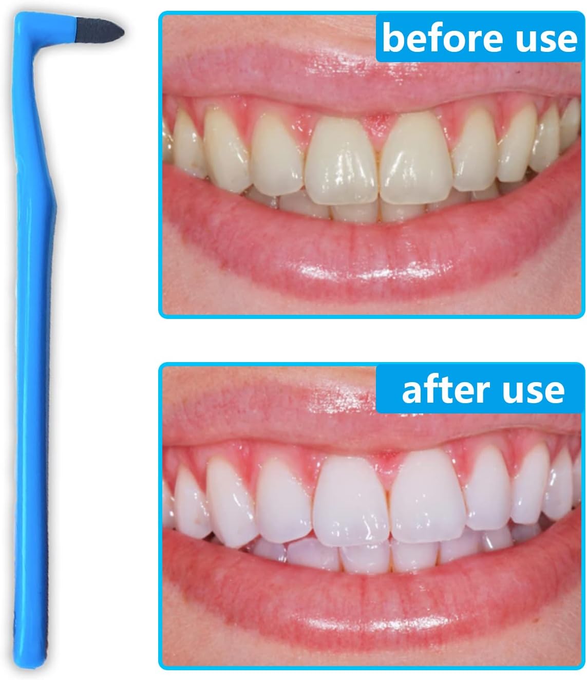 NITAIUN 5 Pieces Remover Tooth Cleaning, Teeth Stain Eraser Teeth