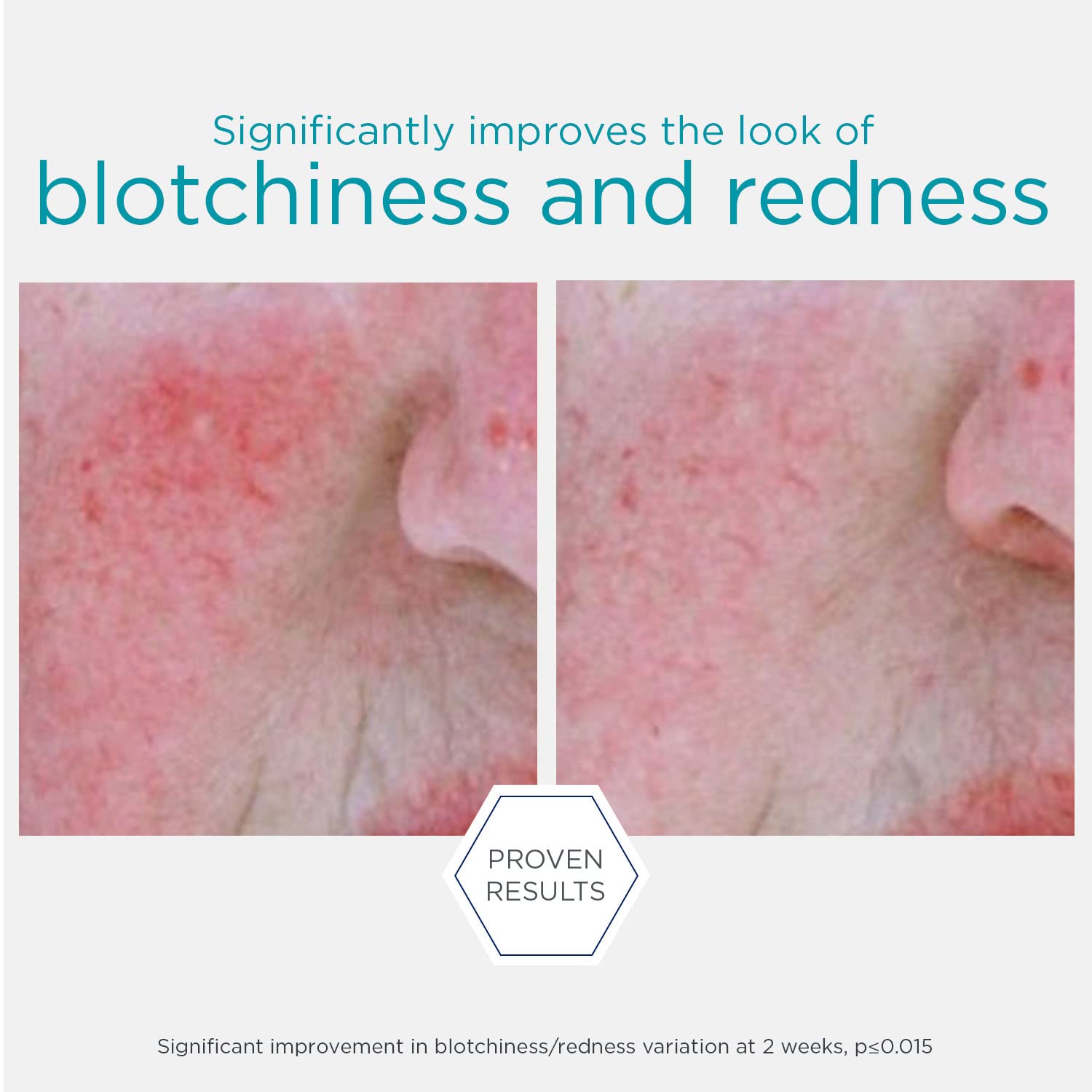 NEOSTRATA Redness Skin Neutralizing Serum Soothing, Hydrating & Cooling Concentrate For Face Oil-Free Fragrance-Free, 29 g