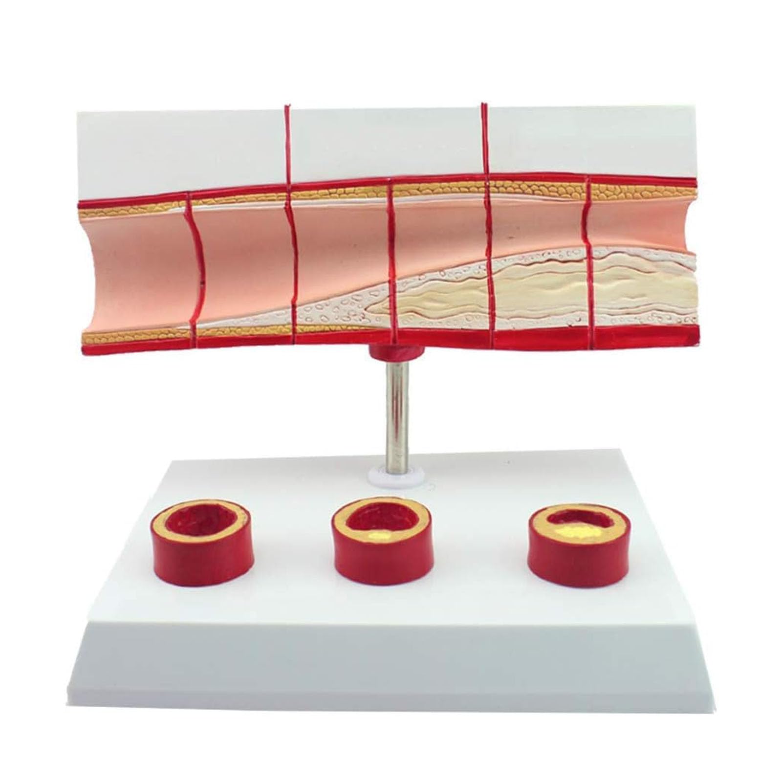 Modèle vasculaire de thrombose AMITD numéroté pour cours médicaux - 7