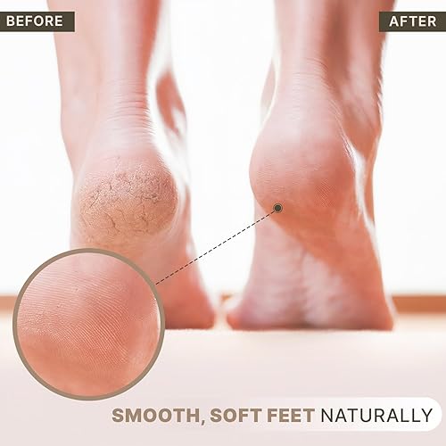 Miniatura 4 de Exfoliante de lava piedra pómez naturales Removal para manos & Rough pies secos Plus, Dead, o duro agrietada Heels mejor para pedicura Callos a &