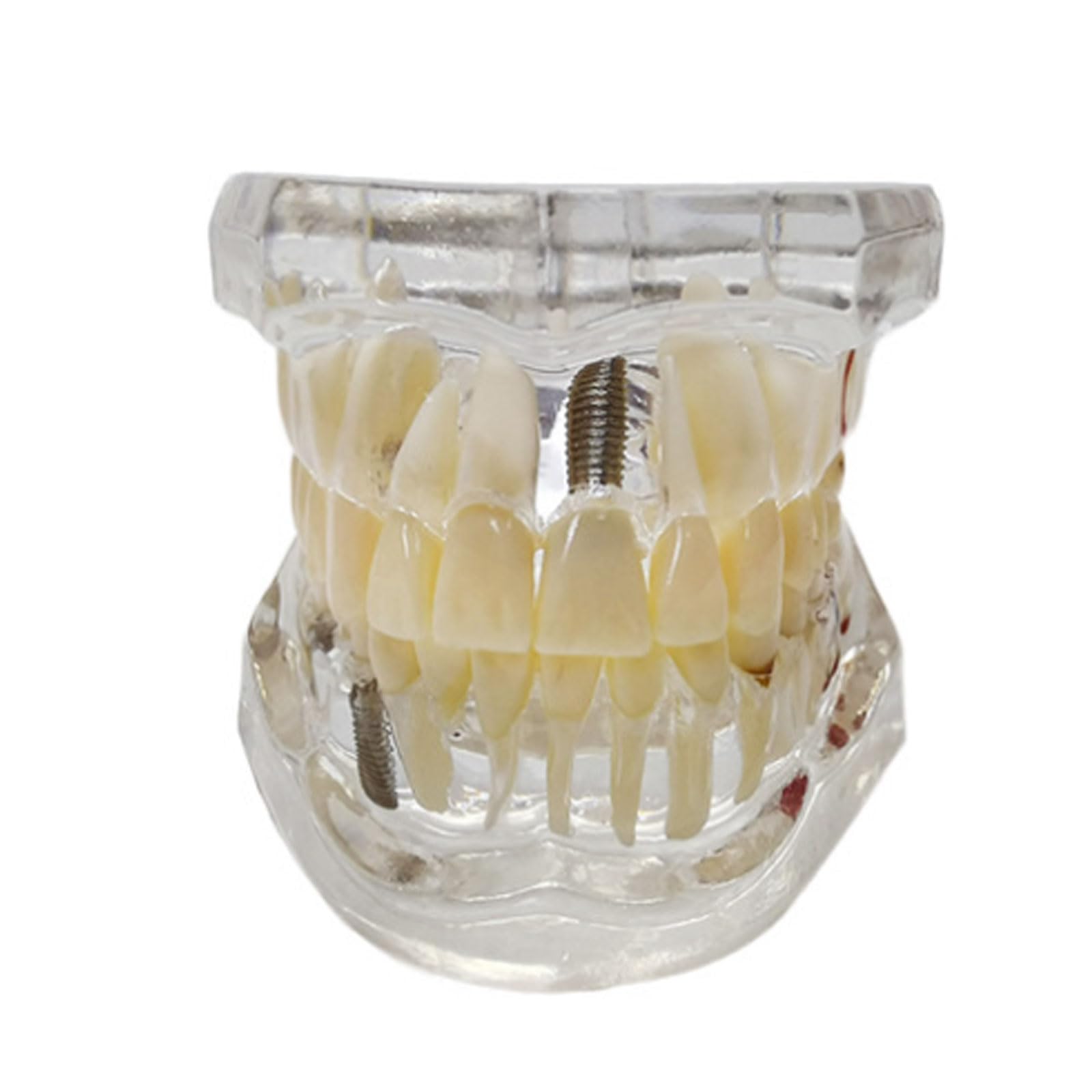 Modello Dentale Denti Impianto Restauro Ponte Insegnamento Studio Scienza Medica Malattia Dentista Odontoiatria Prodotti Regalo Dentale