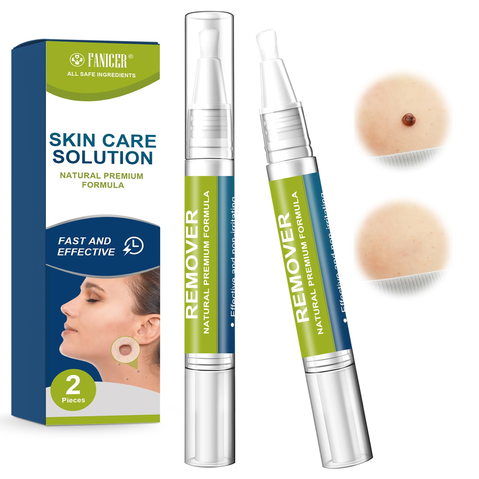 2 * 5ml Lápiz de verrugas, Solución para el cuidado de la piel, adecuada para manos y pies
