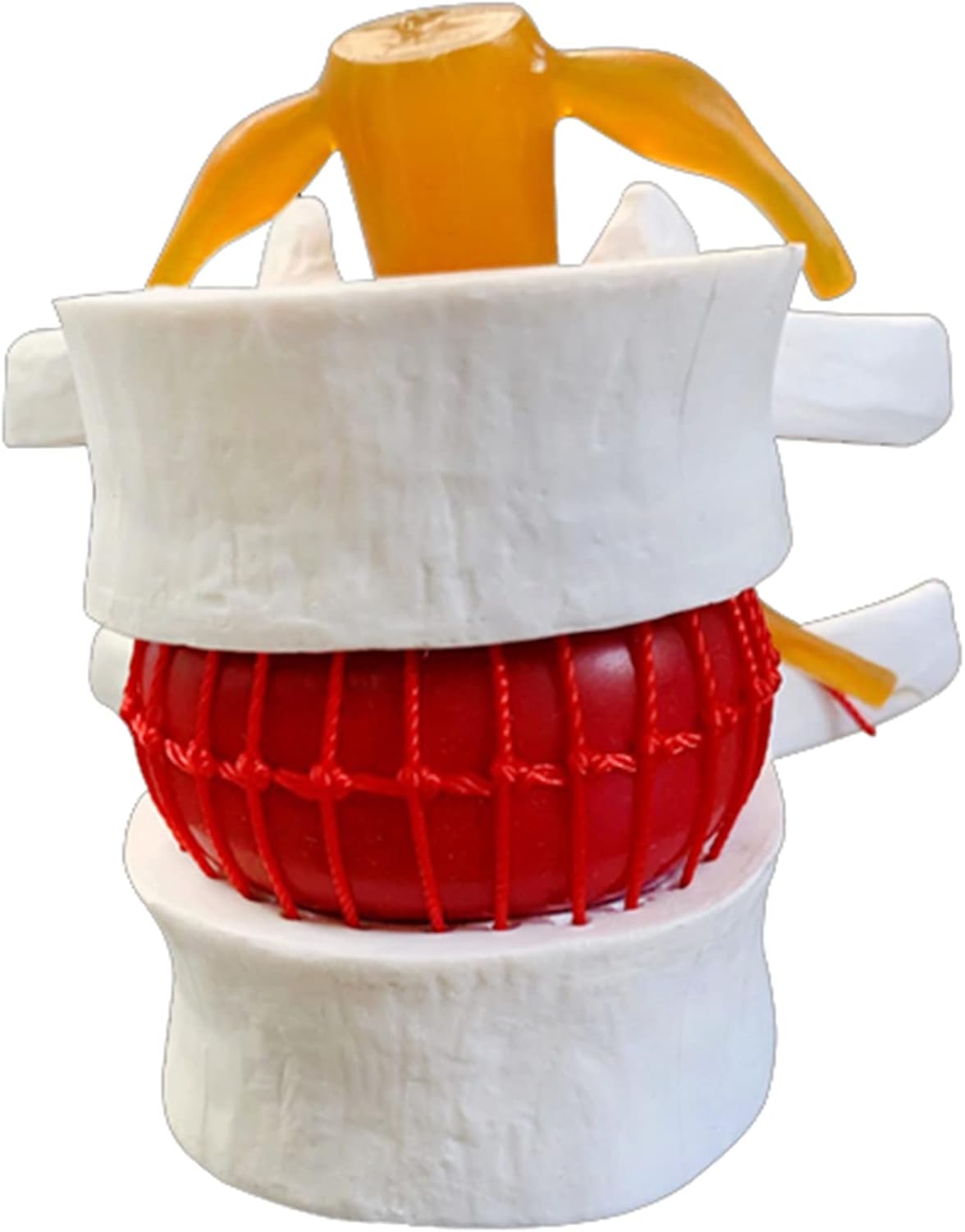 Human Anatomical Lumbar Disc Herniation Model Human Spine Model for Lumbar Spine