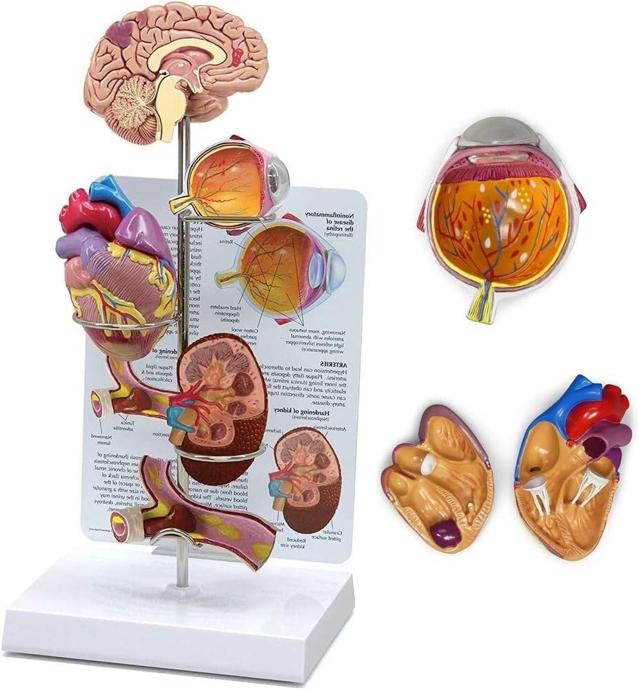 PVC Hypertension Model, Featuring Miniature Brain, Eyes, Heart, Kidneys, and Arteries, Complete with Anatomical Diagrams; a Replica of the