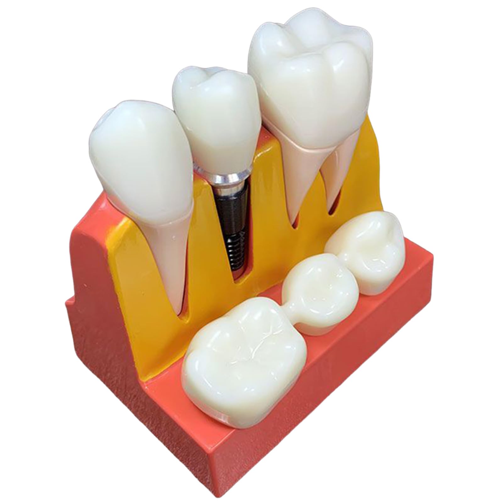 YRQMGSF 4 Times Enlarged Dental lmplant Model Removable Analysis Crown Bridge Demonstration Teeth Model for Learning and Education,A,12CM