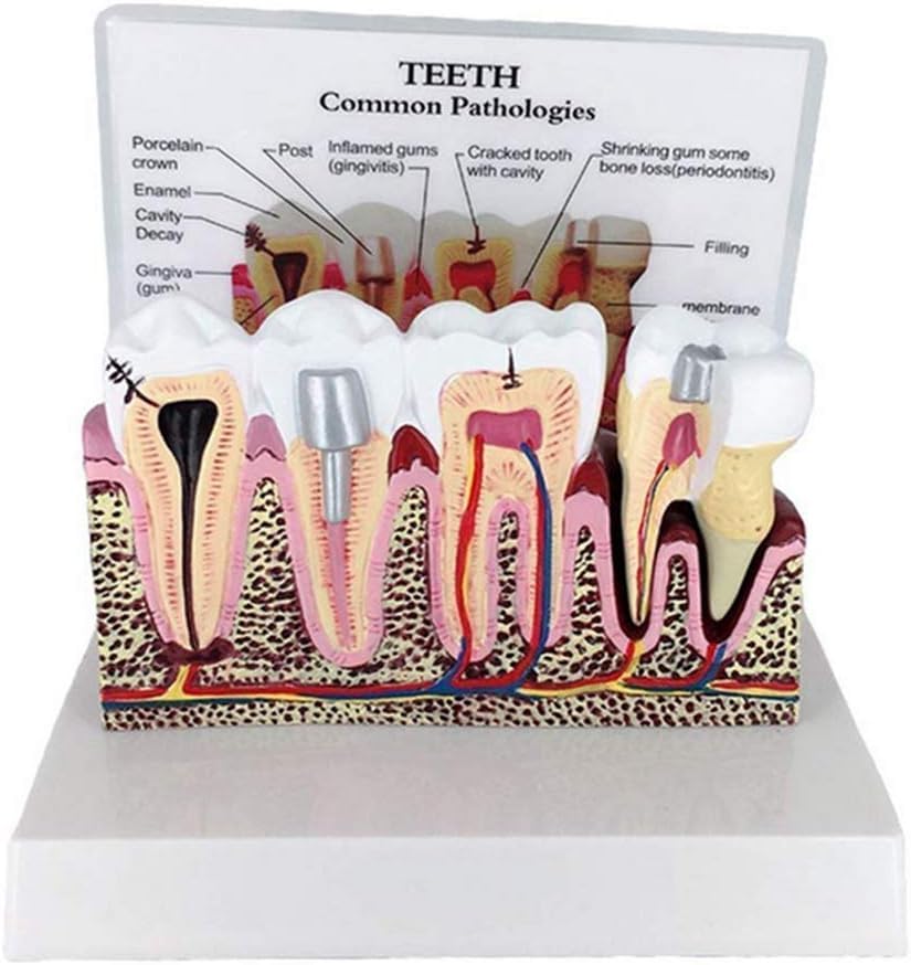 Modèle de section transversale des dents F détachable éducation médicale - 3
