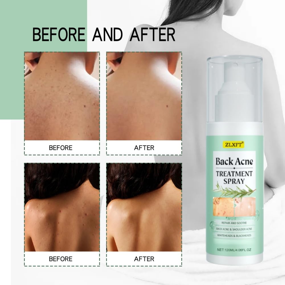 Torna Soluzione Brufolo,2pcs Spray per Brufoli Corpo,Spray per la Rimozione dei Brufoli Sulla Schiena,Post Acne Trattamento Sprays,Acnes Sprays Back And Chest,Body Acnes Sprayss